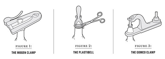 Gomco Clamp Circumcision